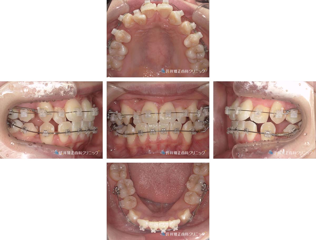 治療中（6ヶ月後）