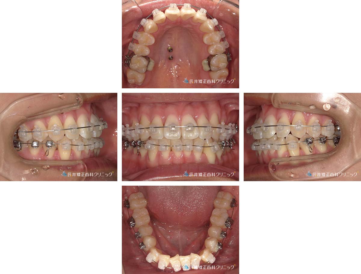 治療中（6ヶ月後）