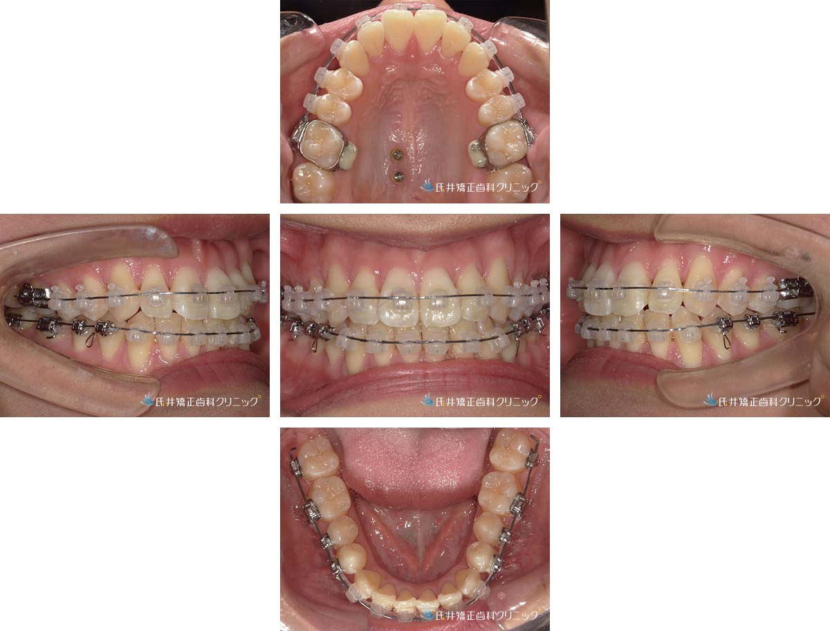 治療中（1年6ヶ月後）