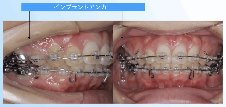 インプラントアンカー（矯正用ネジ）の口腔内写真｜奈良の矯正歯科