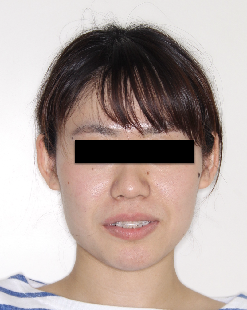 ブラケット装着中の患者さん