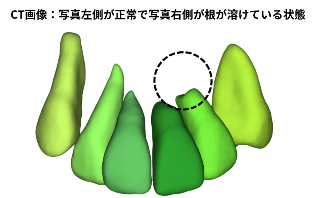 埋伏犬歯による側切歯の歯根吸収CT画像 正常な根と吸収された根の比較｜奈良の矯正歯科 氏井矯正歯科クリニック