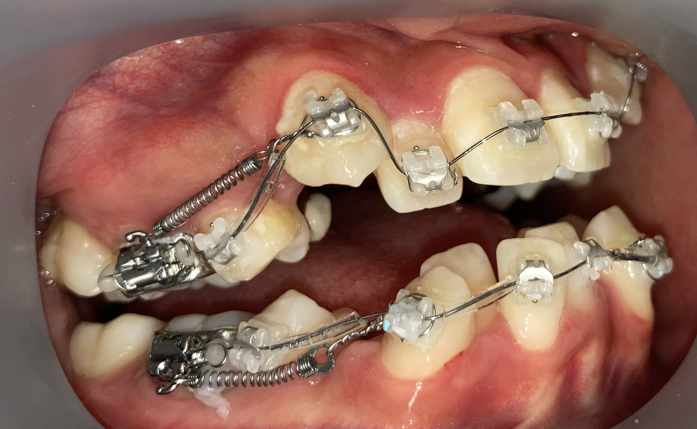 抜歯矯正1週間後の経過写真｜隙間閉鎖の経過｜奈良の矯正歯科