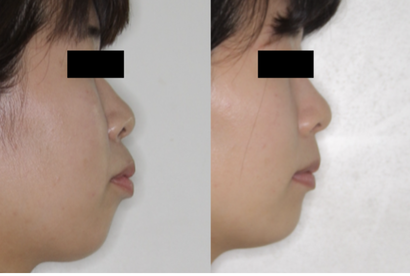 口ゴボ・ガミースマイルの矯正｜奈良の矯正歯科