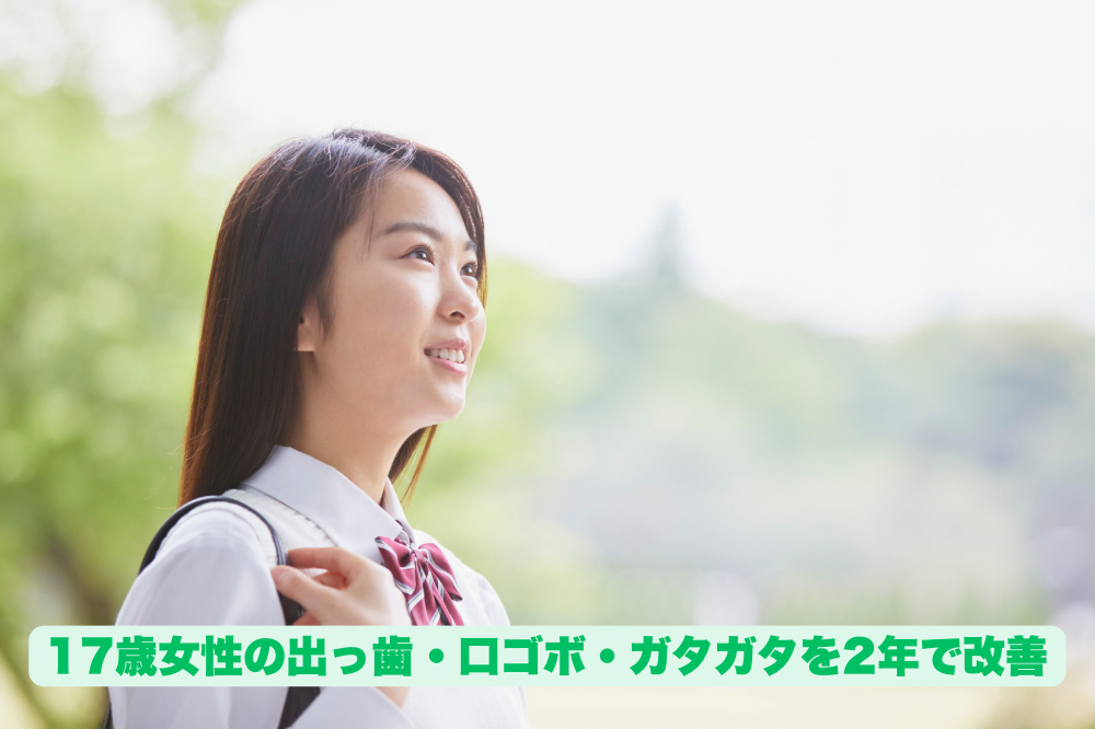 17歳女性の出っ歯・口ゴボ・ガタガタを2年で改善