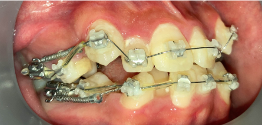 抜歯矯正2週間後の経過写真｜隙間閉鎖の経過｜奈良の矯正歯科