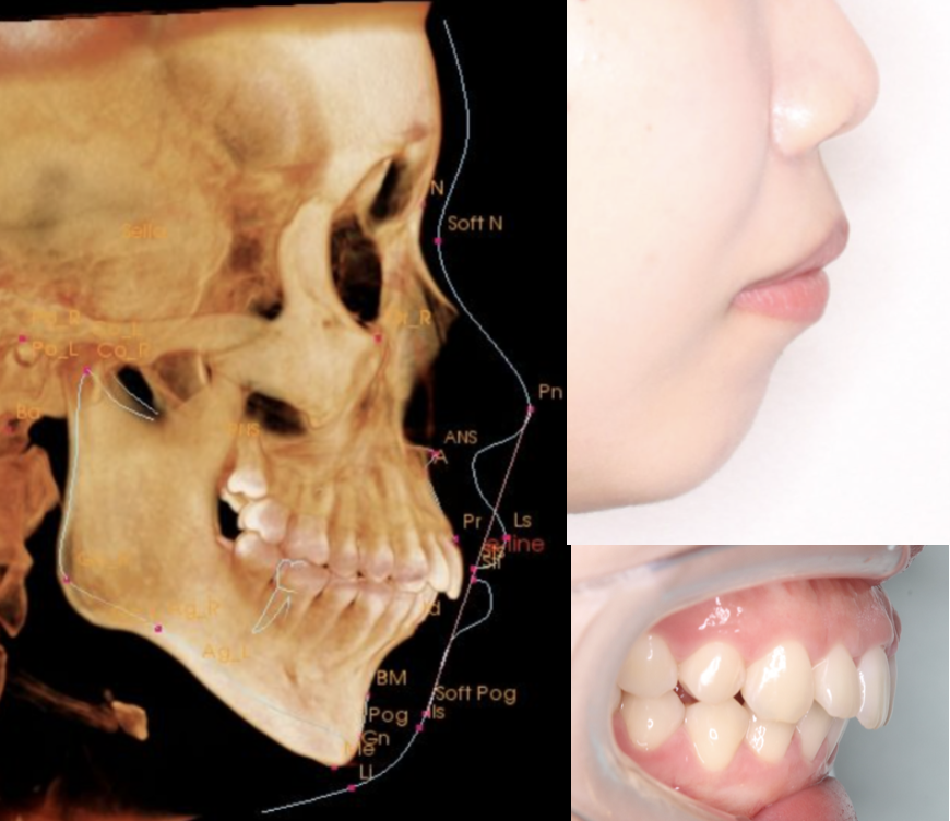 骨格的な出っ歯・口ゴボのイメージ