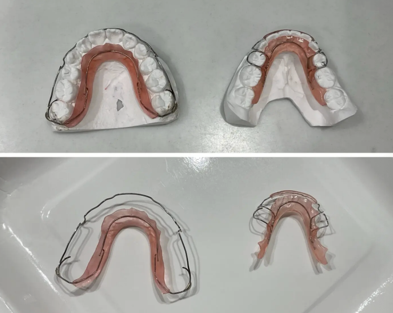 歯列模型に装着したワイヤー型保定装置（ホーレーリテーナー）の写真｜奈良の矯正歯科