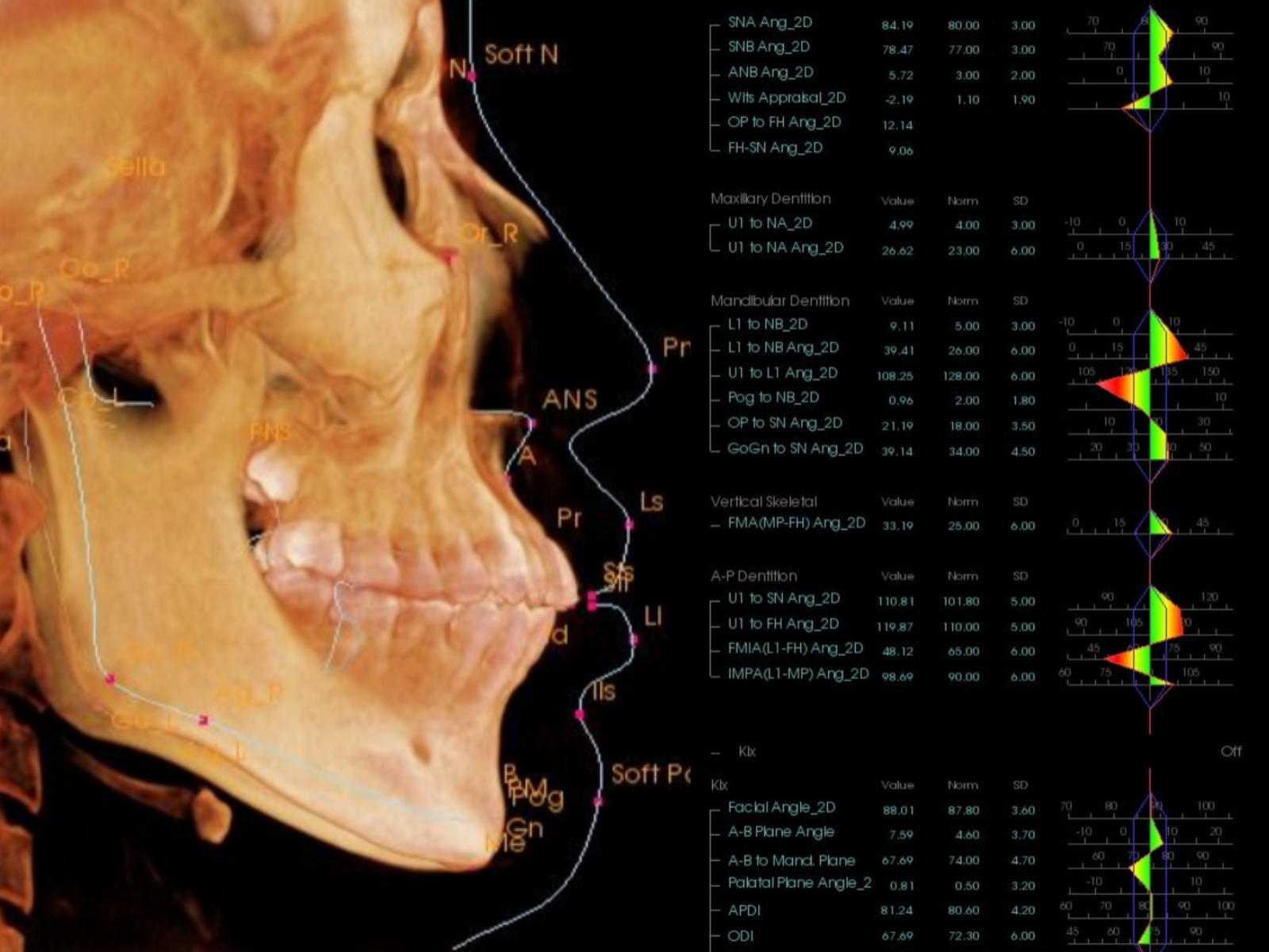 先天性欠如歯 セファロ分析｜奈良の矯正歯科 氏井矯正歯科クリニック