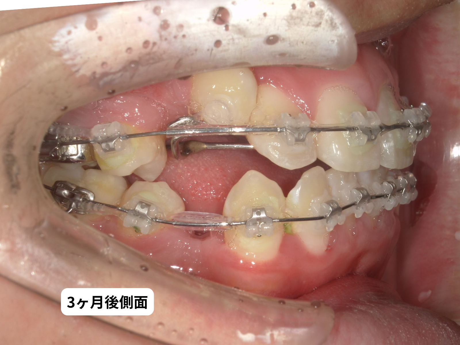 犬歯埋伏 治療3ヶ月後の口の中5枚組｜奈良の矯正歯科 氏井矯正歯科クリニック