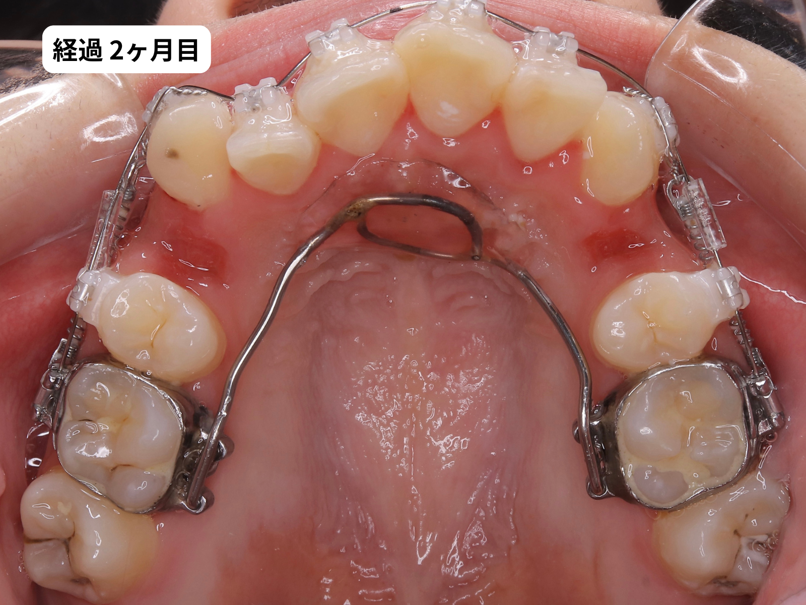 矯正治療2ヶ月目の上顎咬合面｜でこぼこ矯正経過・奈良の矯正歯科