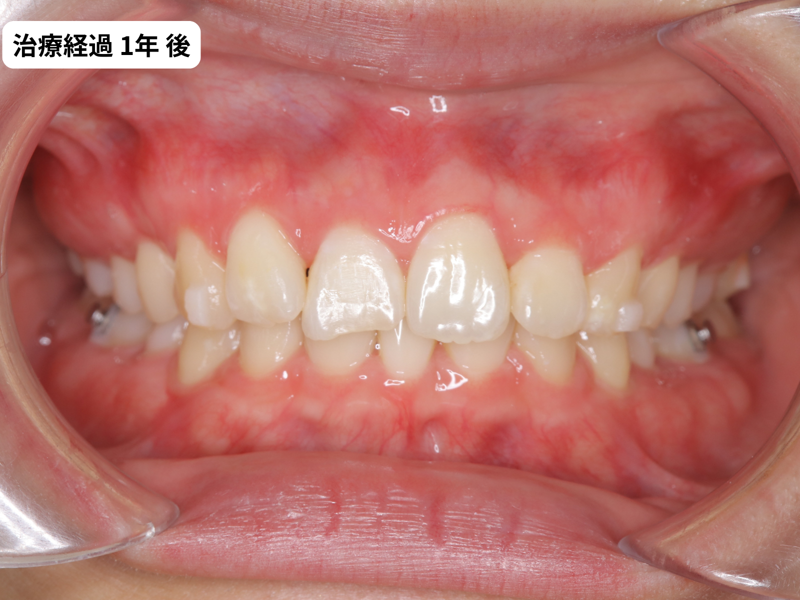 矯正治療1年目の正面｜過蓋咬合改善経過｜奈良の矯正歯科