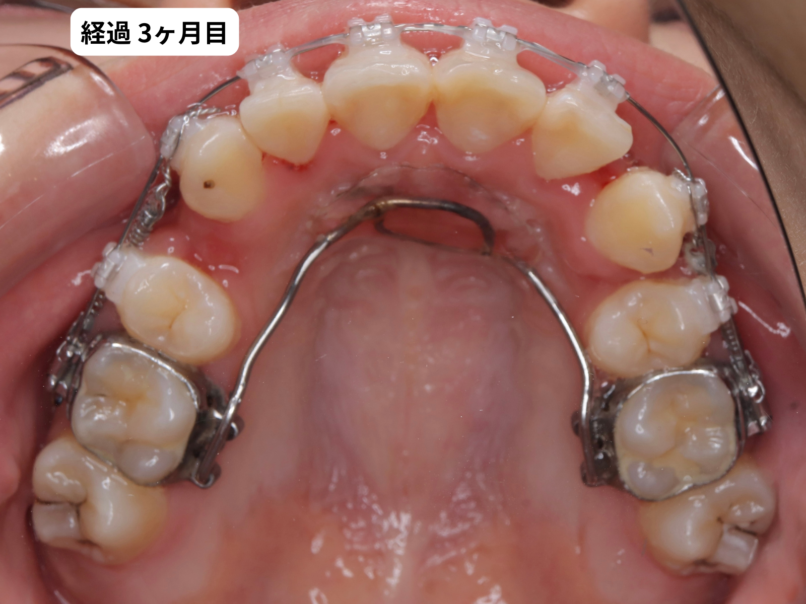 矯正治療3ヶ月目の上顎咬合面｜でこぼこ矯正経過・奈良の矯正歯科