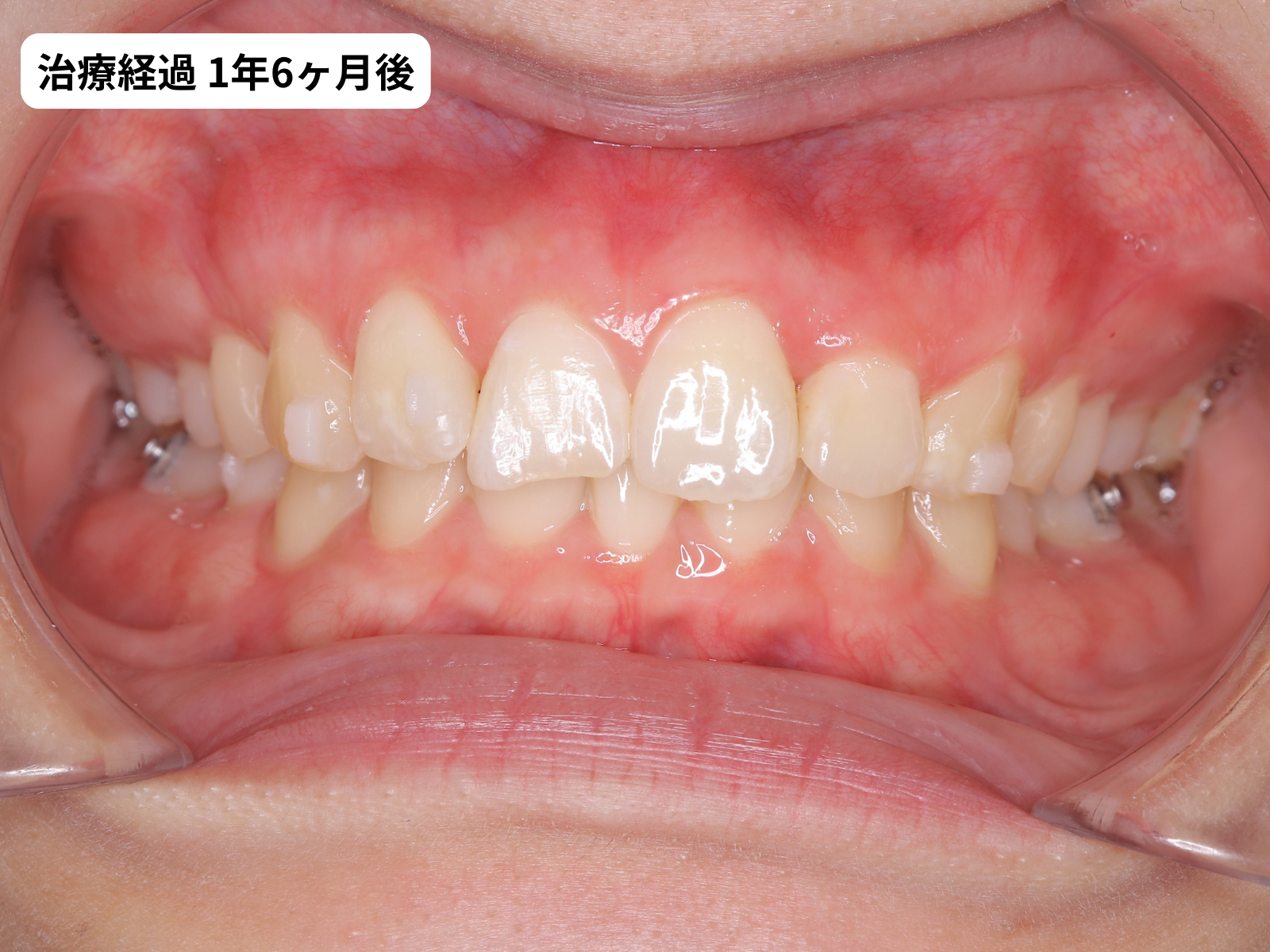 矯正治療1年6ヶ月目の正面｜過蓋咬合改善経過｜奈良の矯正歯科