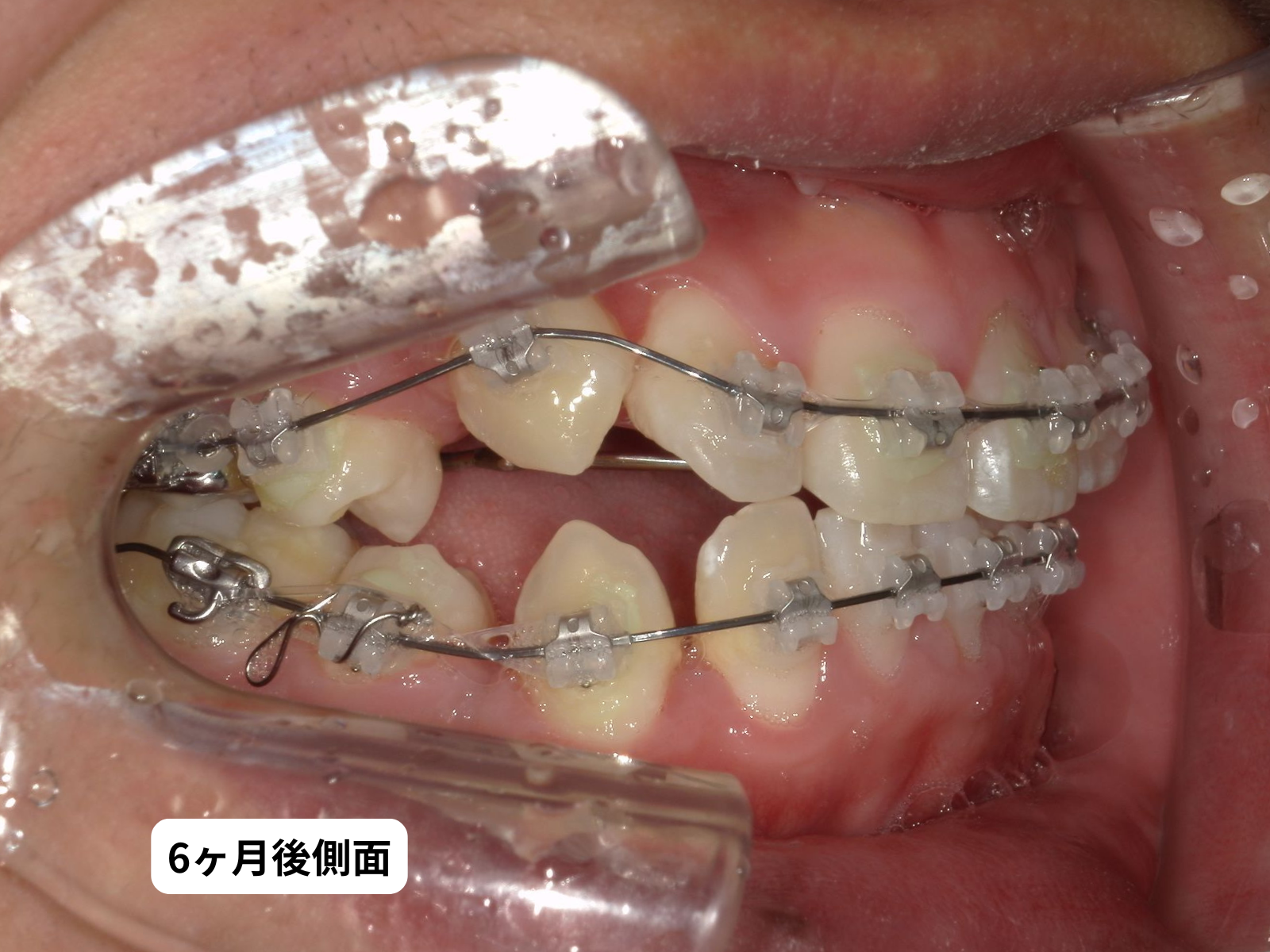 犬歯埋伏 治療6ヶ月後の口の中5枚組｜奈良の矯正歯科 氏井矯正歯科クリニック