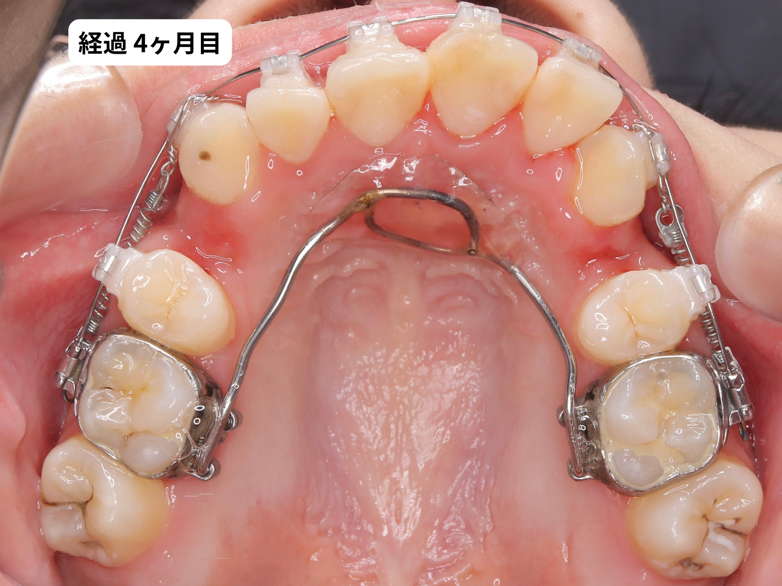 矯正治療4ヶ月目の上顎咬合面｜でこぼこ矯正経過・奈良の矯正歯科