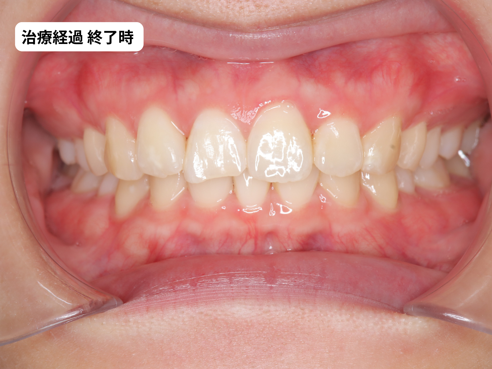 矯正治療終了時の正面｜過蓋咬合改善後｜奈良の矯正歯科