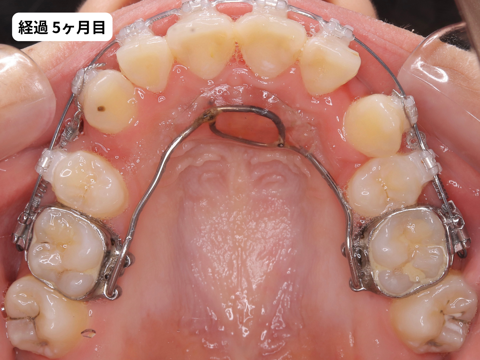 矯正治療5ヶ月目の上顎咬合面｜でこぼこ矯正経過・奈良の矯正歯科