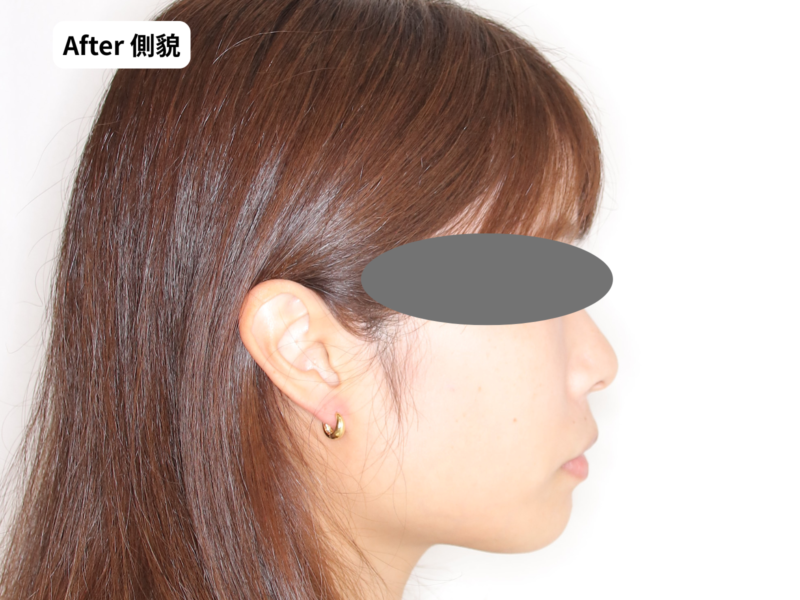 矯正治療後の側貌｜口元バランス｜奈良の矯正歯科