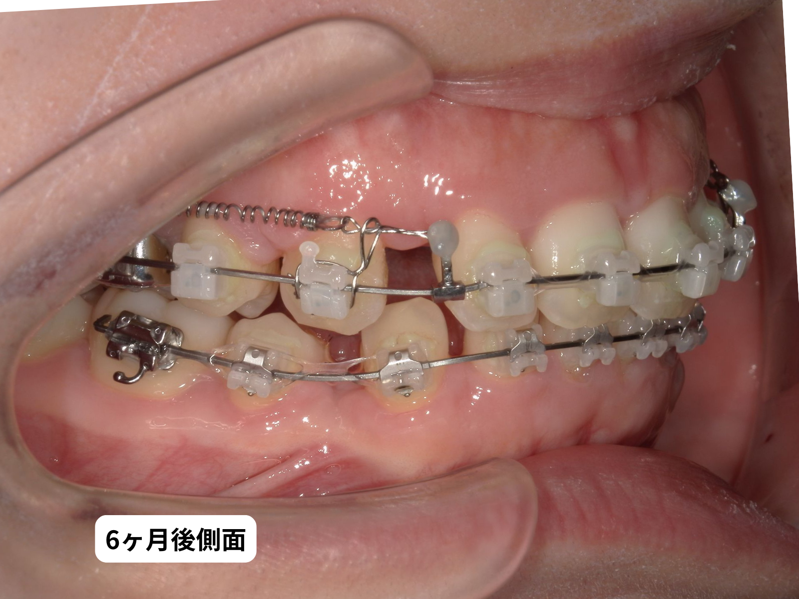 治療開始 半年後 側貌+口腔内（79-05b）｜奈良の矯正歯科