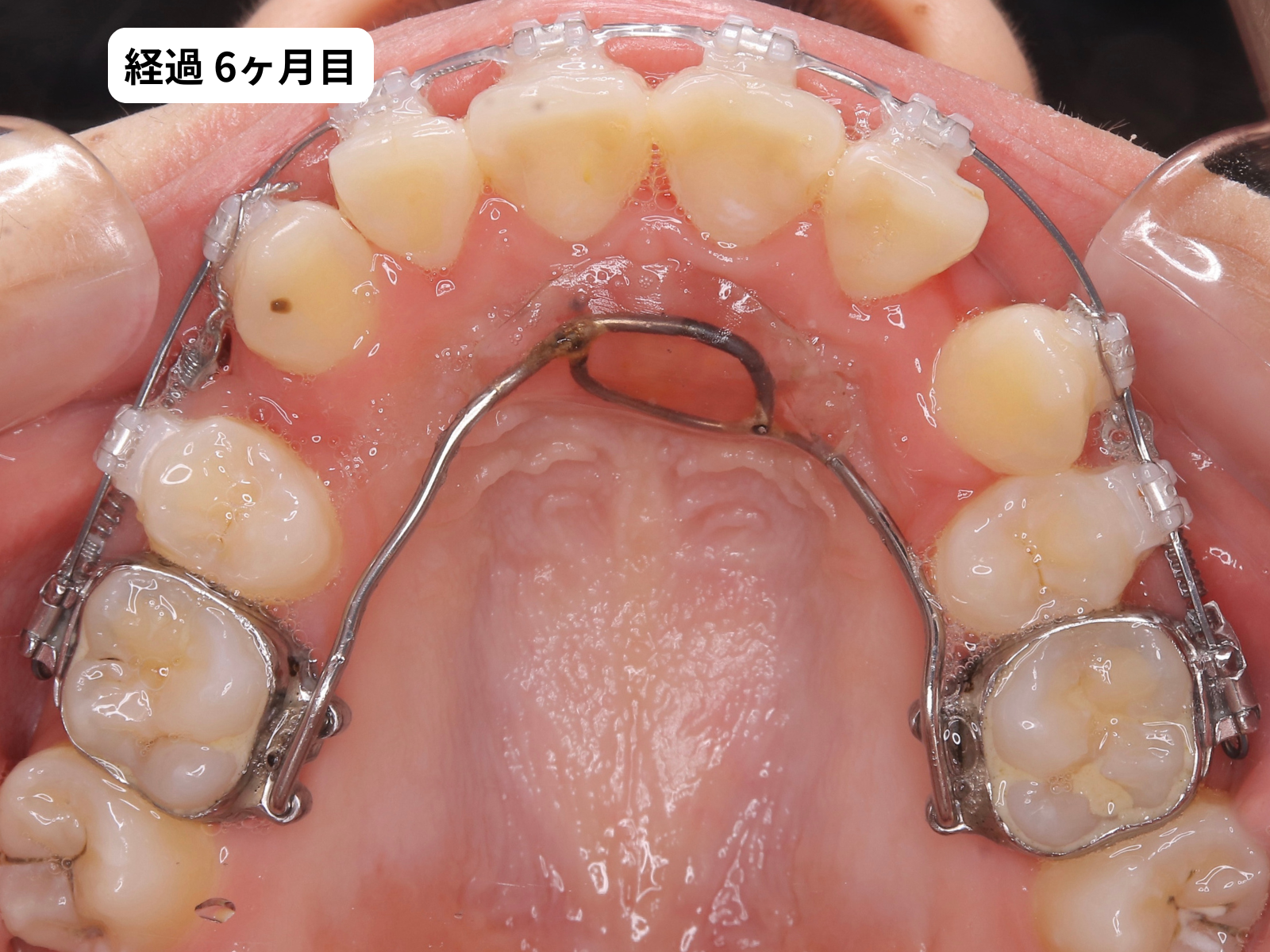 矯正治療6ヶ月目の上顎咬合面｜でこぼこ矯正経過・奈良の矯正歯科