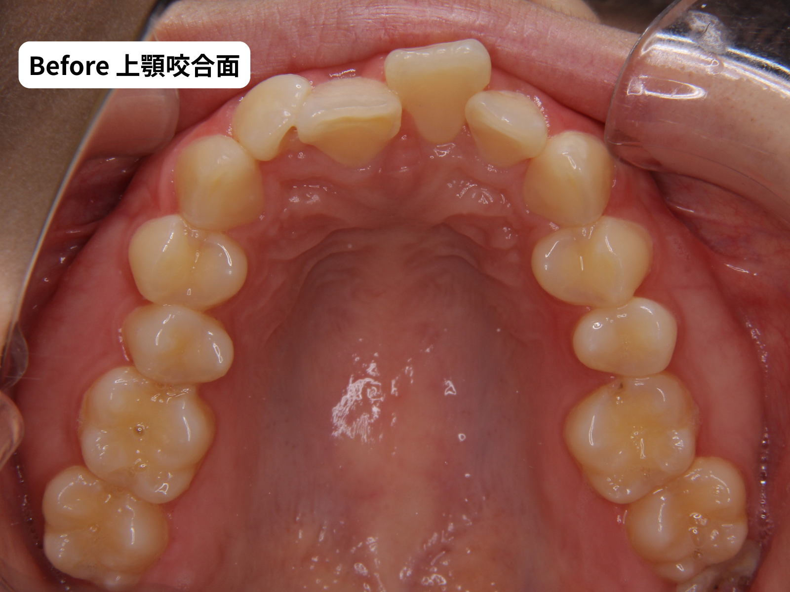 矯正治療前の上顎咬合面｜奈良の矯正歯科