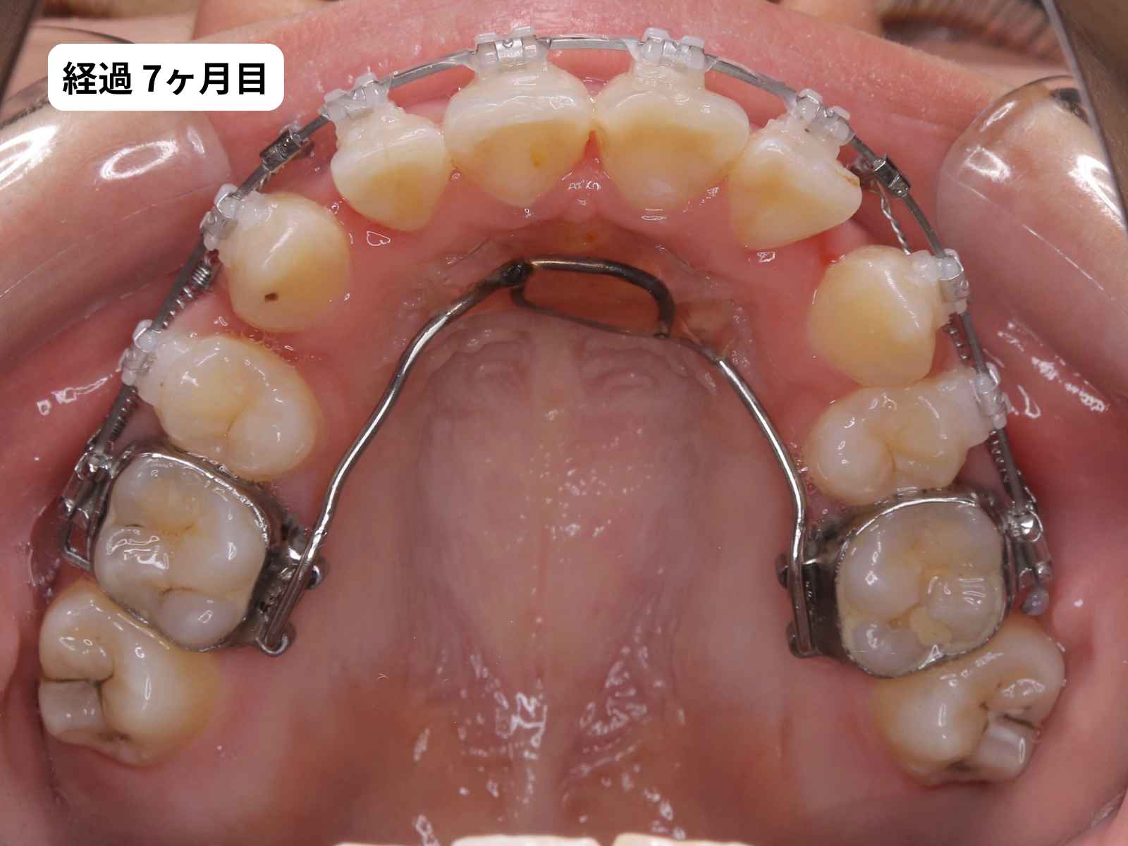 矯正治療7ヶ月目の上顎咬合面｜でこぼこ矯正経過・奈良の矯正歯科