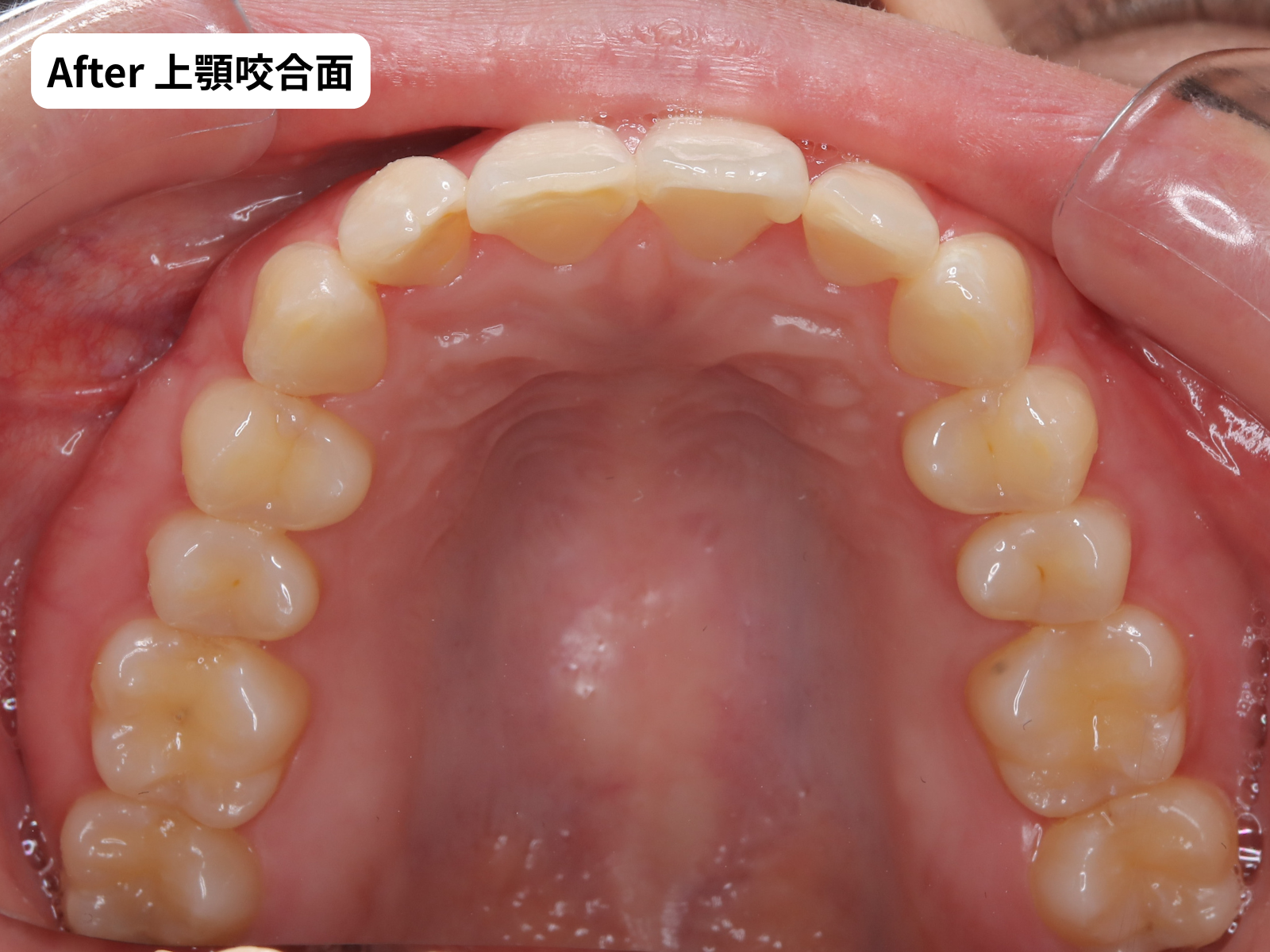 矯正治療後の上顎咬合面｜奈良の矯正歯科