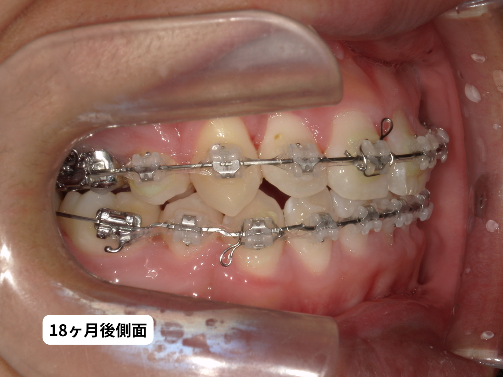 犬歯埋伏 治療1年6ヶ月後の口の中5枚組｜奈良の矯正歯科 氏井矯正歯科クリニック