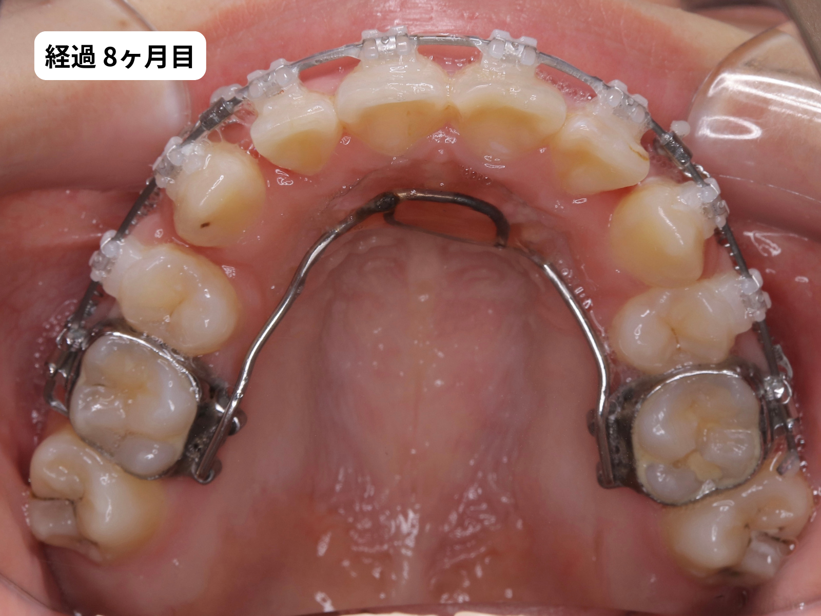 矯正治療8ヶ月目の上顎咬合面｜でこぼこ矯正経過・奈良の矯正歯科