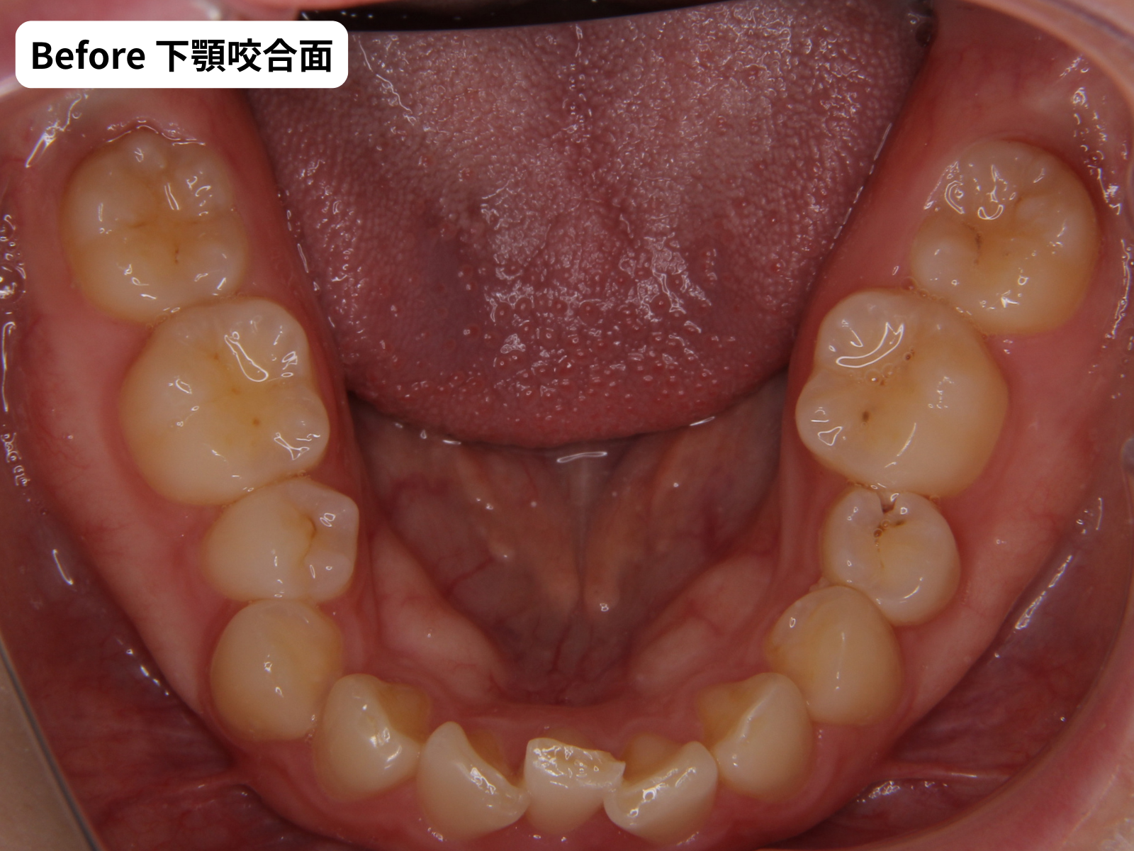 矯正治療前の下顎咬合面｜先天欠如あり｜奈良の矯正歯科