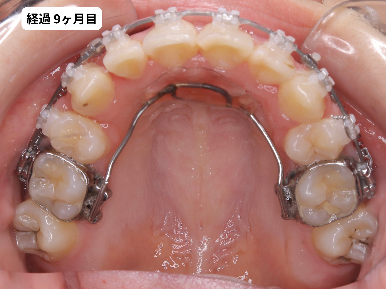 矯正治療9ヶ月目の上顎咬合面｜でこぼこ矯正経過・奈良の矯正歯科