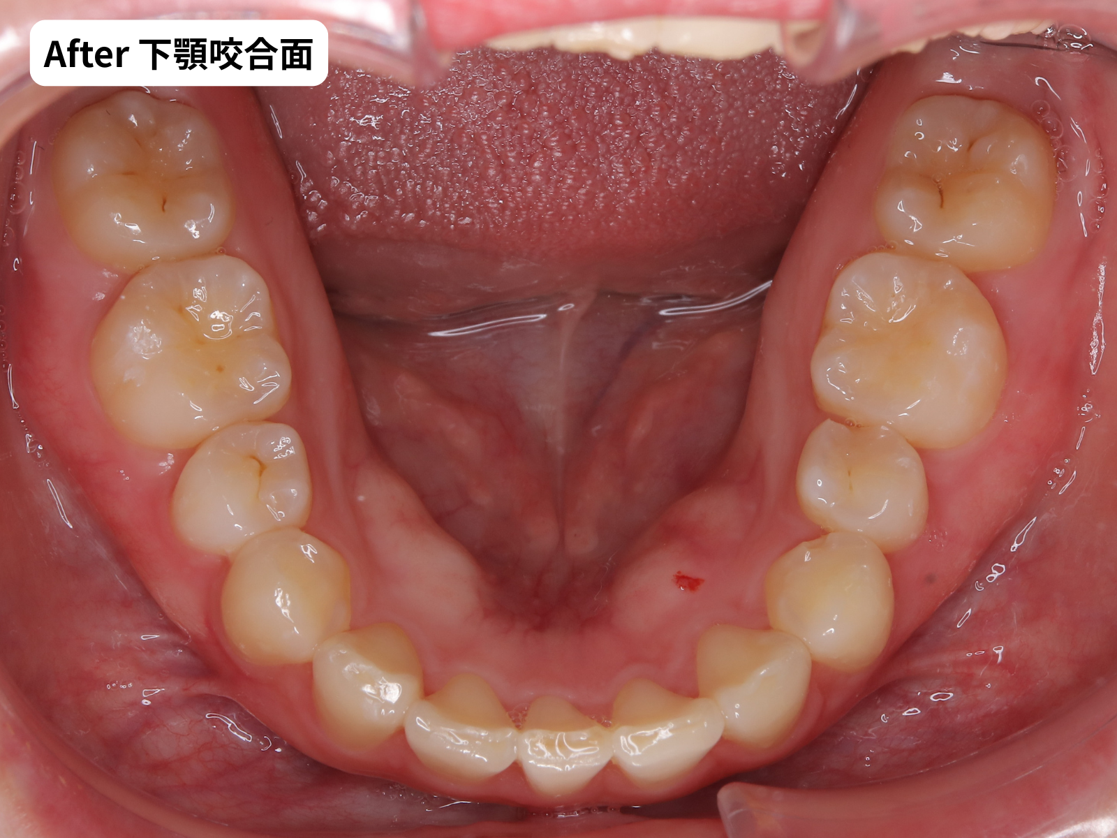矯正治療後の下顎咬合面｜奈良の矯正歯科