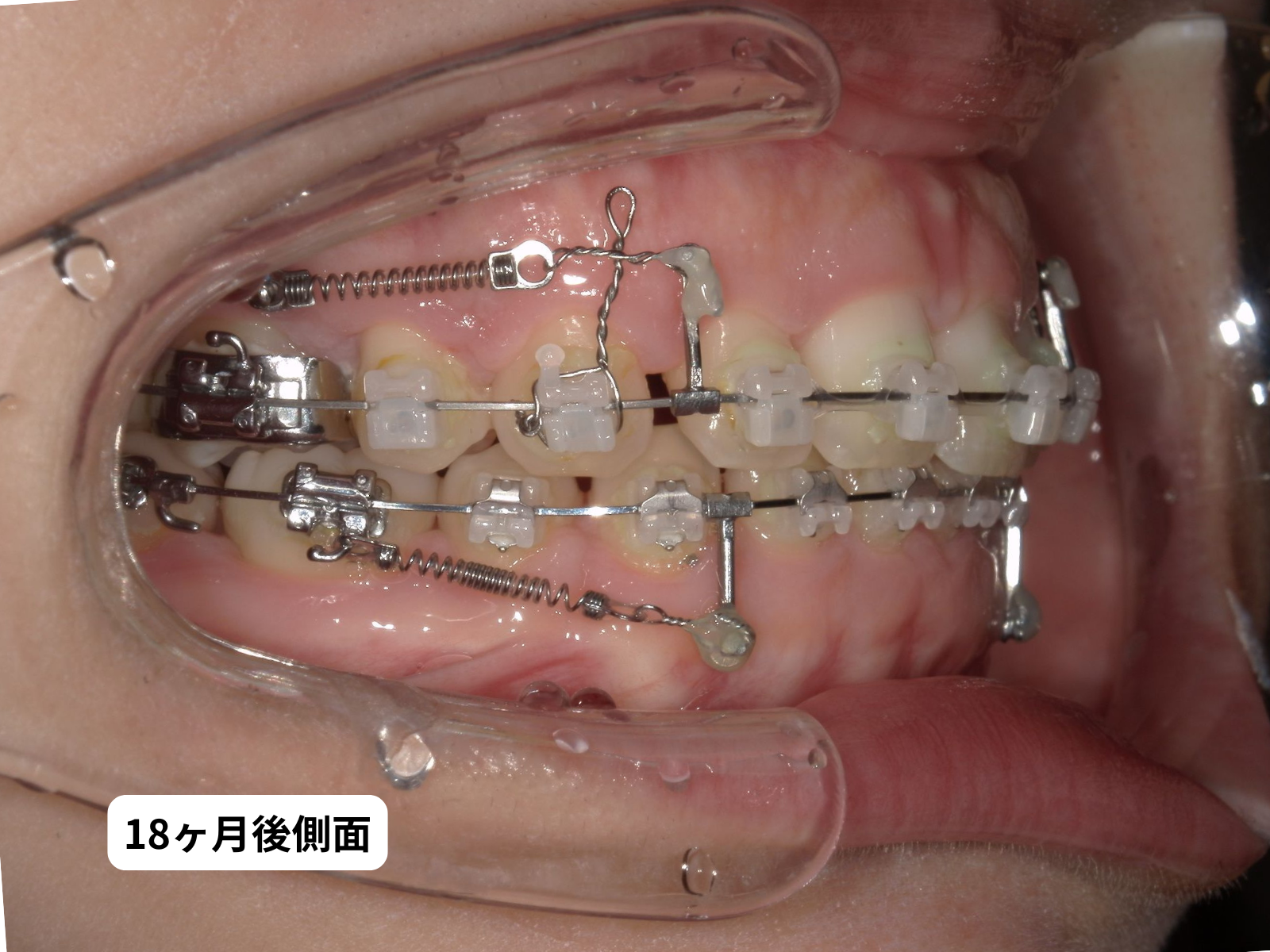 治療開始 1年半後 口腔内（79-05c）｜奈良の矯正歯科