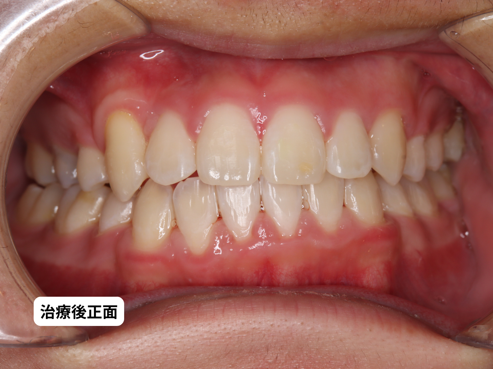 犬歯埋伏 治療前後 口の中正面｜奈良の矯正歯科 氏井矯正歯科クリニック
