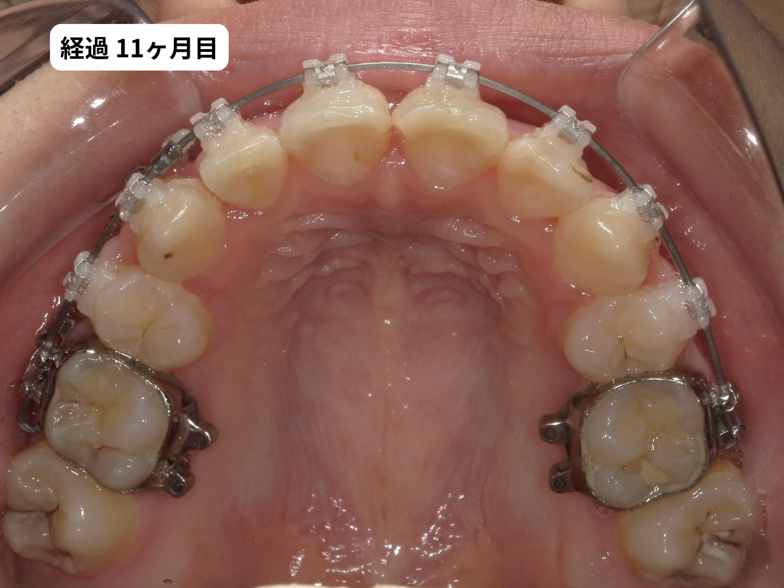 矯正治療11ヶ月目の上顎咬合面｜でこぼこ矯正経過・奈良の矯正歯科