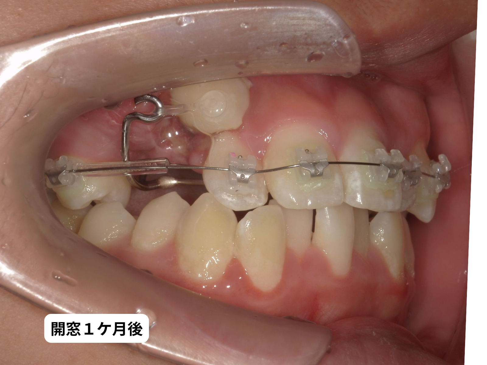 犬歯埋伏 開窓処置1ヶ月後の口の中5枚組｜奈良の矯正歯科 氏井矯正歯科クリニック