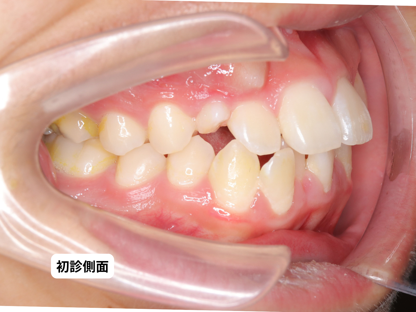 犬歯埋伏 初診時の口の中｜奈良の矯正歯科 氏井矯正歯科クリニック