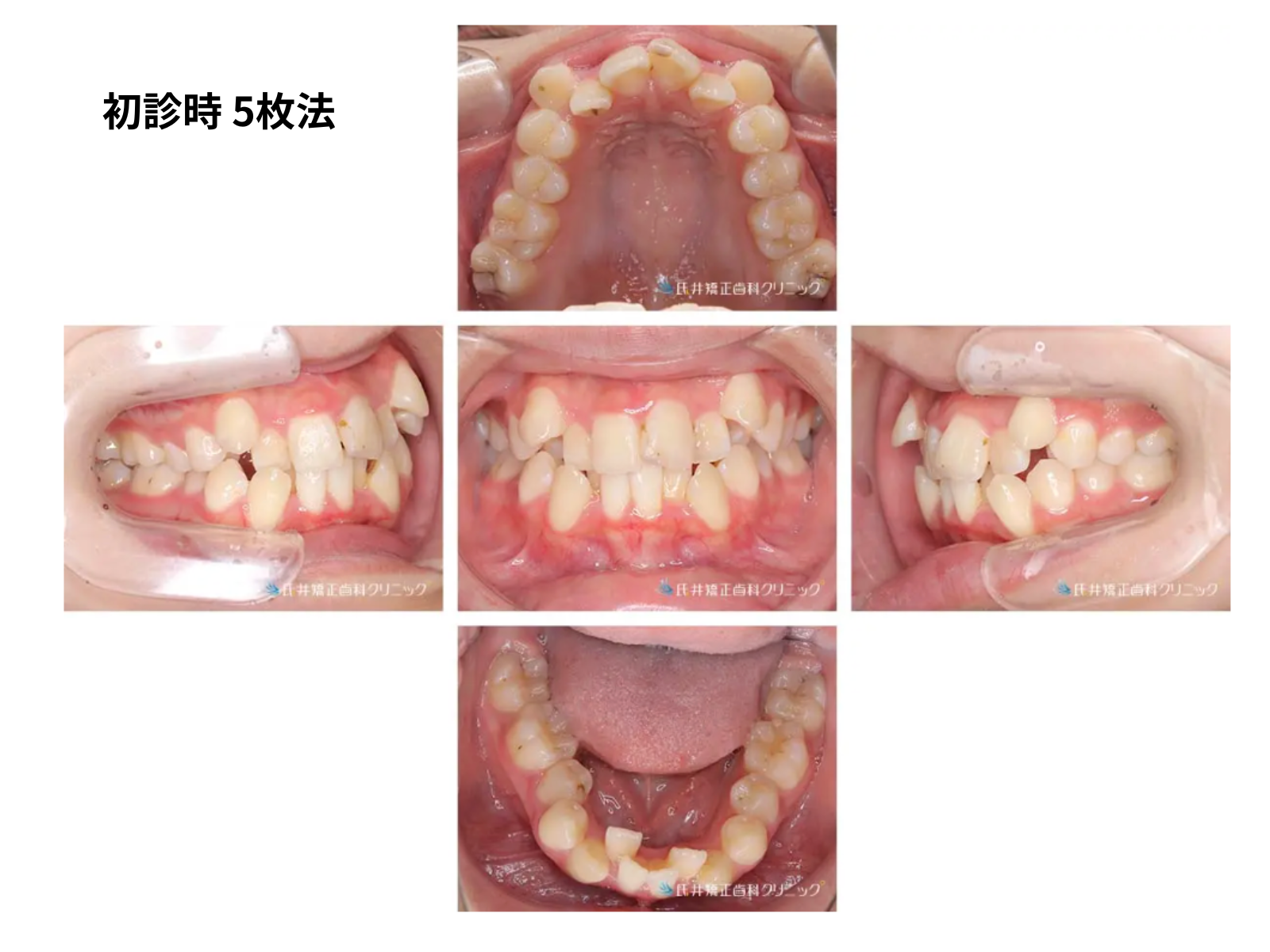 初診時の口腔内5枚法｜でこぼこ(八重歯)矯正・奈良の矯正歯科