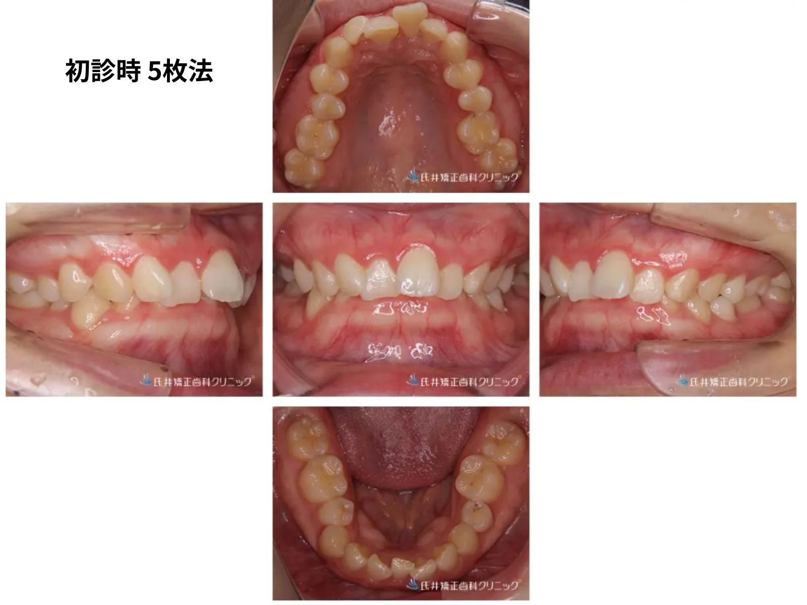 初診時の口腔内5枚法｜重度過蓋咬合｜奈良の矯正歯科