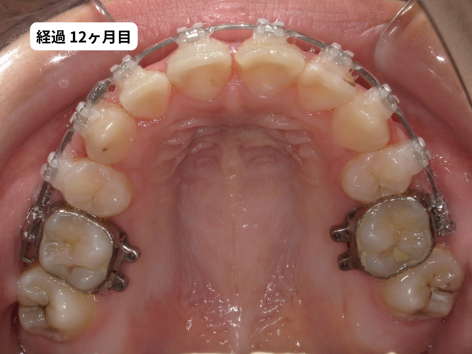 矯正治療12ヶ月目の上顎咬合面｜でこぼこ矯正経過・奈良の矯正歯科