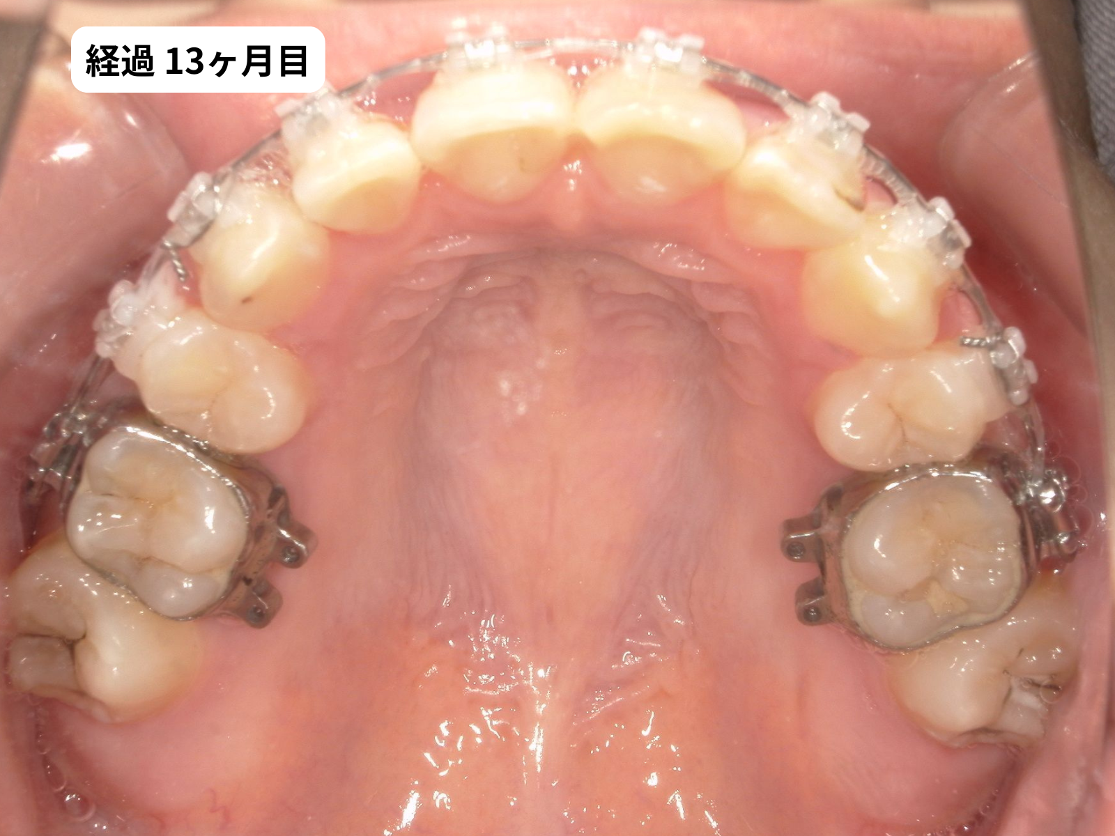 矯正治療13ヶ月目の上顎咬合面｜でこぼこ矯正経過・奈良の矯正歯科