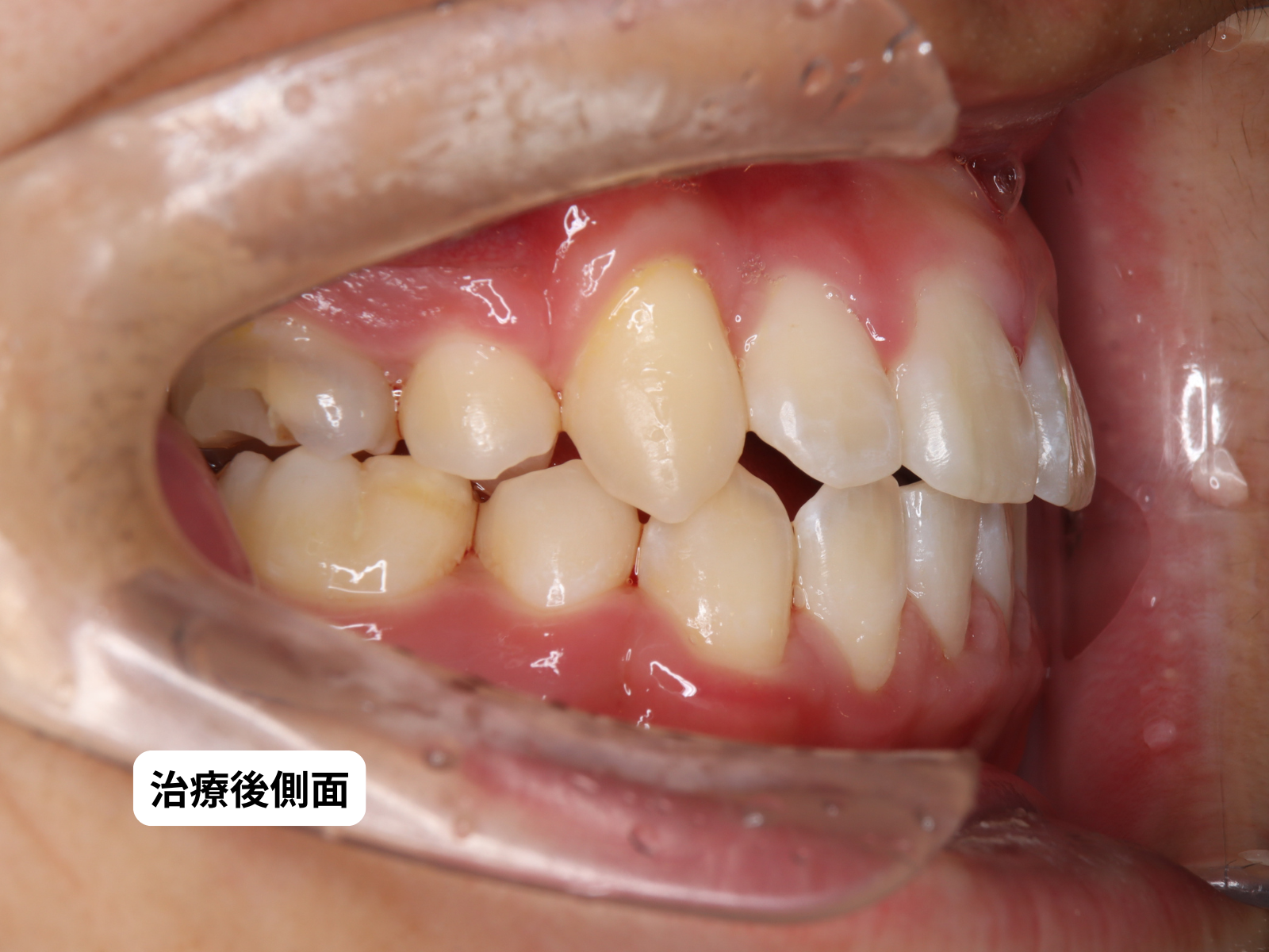 犬歯埋伏 治療前後 口の中右側面｜奈良の矯正歯科 氏井矯正歯科クリニック