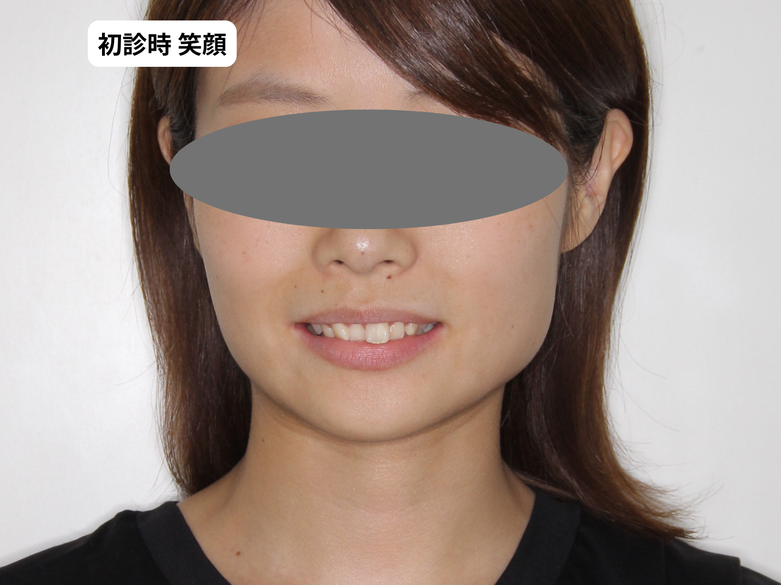 矯正治療前の笑顔(26歳女性)｜奈良の矯正歯科