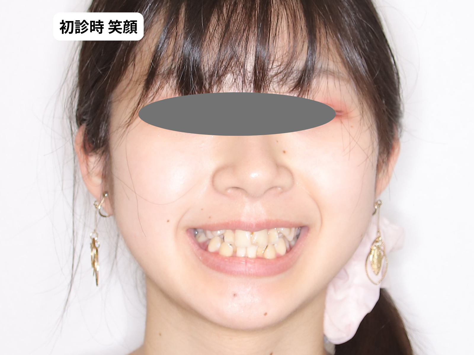 矯正治療前の笑顔(19歳女性)｜でこぼこ(八重歯)・奈良の矯正歯科