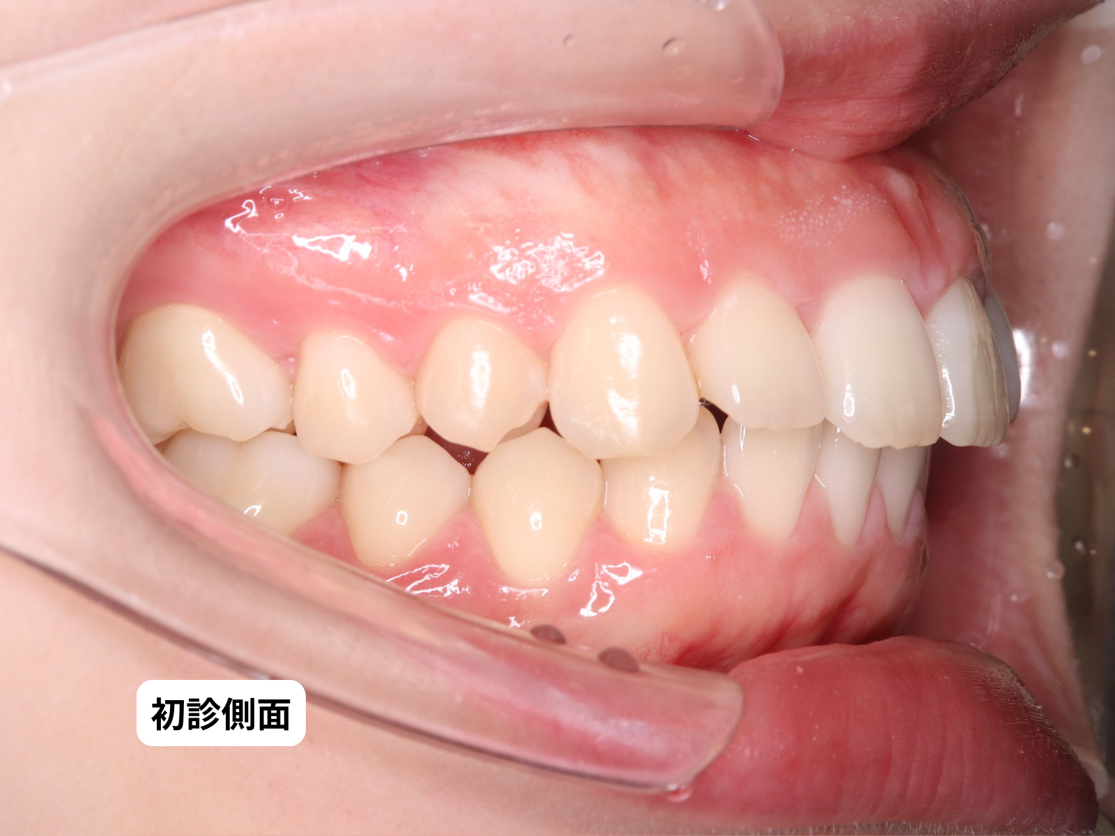 初診時口腔内 Before（79-BA2a）｜奈良の矯正歯科