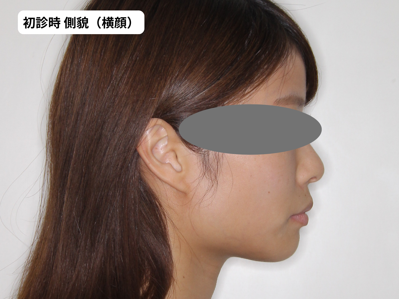 矯正治療前の側貌(横顔)｜口元評価｜奈良の矯正歯科