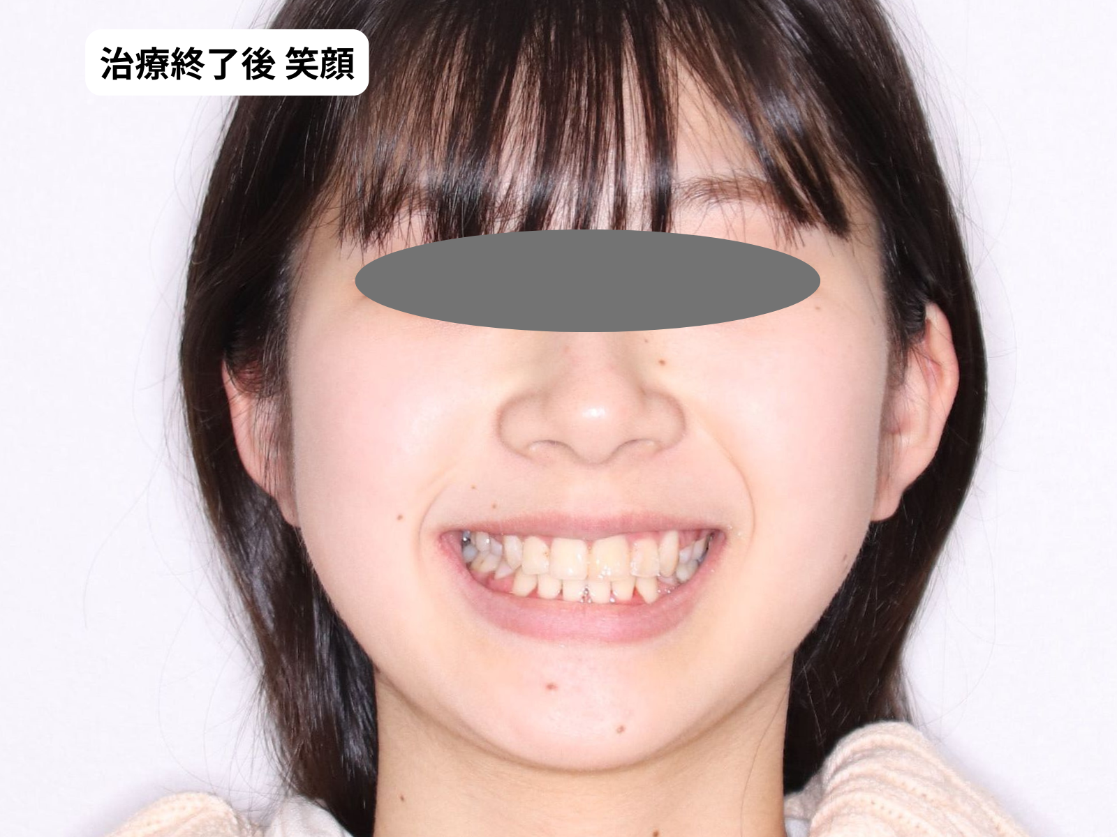 矯正治療後の笑顔(24歳女性)｜でこぼこ矯正・奈良の矯正歯科