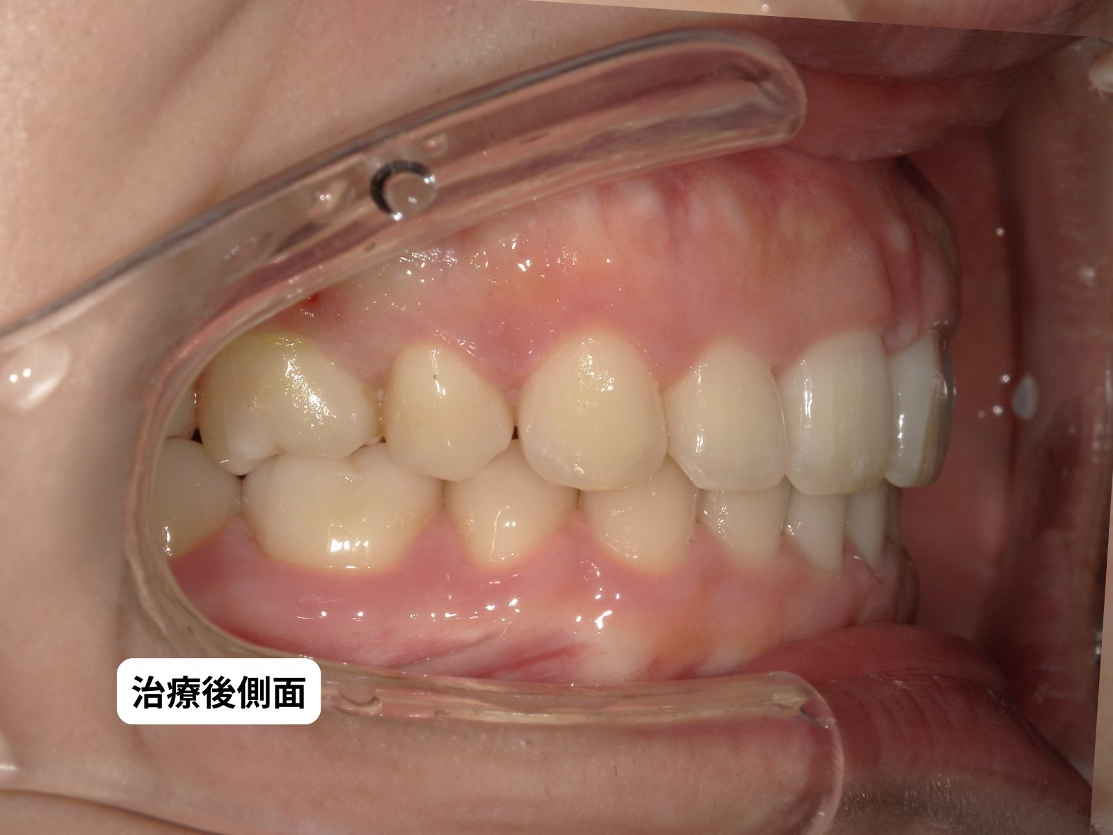 治療後 口腔内（79-06）｜奈良の矯正歯科