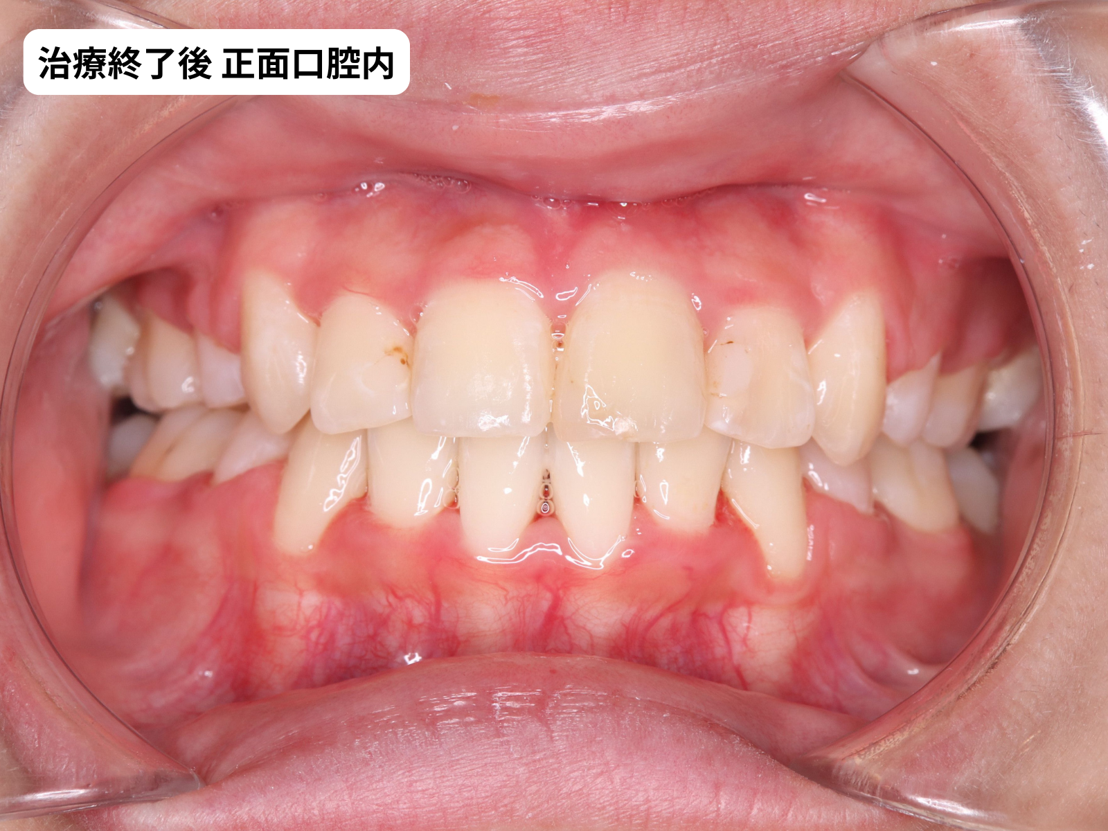 矯正治療後の正面口腔内｜でこぼこ改善症例・奈良の矯正歯科